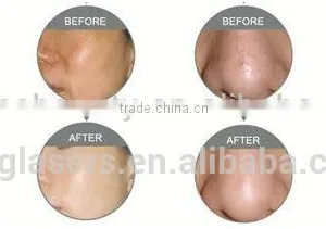 Facial Veins Treatment Professional Manufacture Sanhe 1000W Beauty Machine Nd Yag Laser Machine thumbnail-6