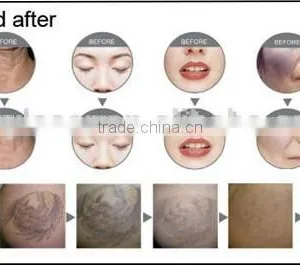 nd Yag Laser With Black Tip for Skin Whitening Laser Carbon Treatment thumbnail-4