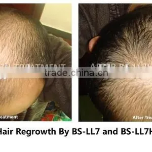 Professional Low Level Laser Therapy Hair Loss Treatment Hair Growth Machine To Men And Women thumbnail-5