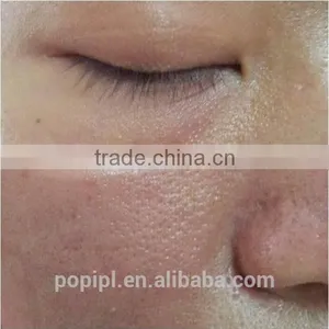 Spot Scar Pigment Removal Popipl Lady Laser Beauty Fractional Co2 Laser Equipment Scar Removal Professional thumbnail-4