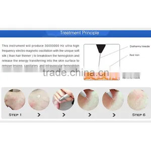 30MHz RBS Beauty Machine Coagulation Vessels Laser Blood Vessel Removal Device thumbnail-6