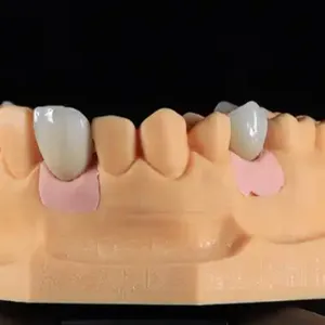 Dental Telescope Denture, Telesope Crown, Dental Prothesis, Laboratoire Dentaire, Dentallabor,Dental thumbnail-2