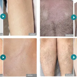 Triple Wavelength 808nm 755nm 1064nm Diode Laser Hair Removal Machine 10Hz Repetition Rate 3-Handle thumbnail-3