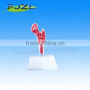 Human Skeleton Model Pathological Femur Model thumbnail-1