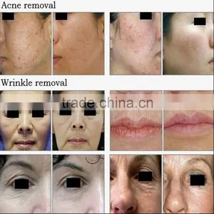 Portable Fractional Erbium Laser for Scars With CE Free Shipping thumbnail-6