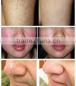 Spider Vascular Vein Removal Machine 980nm Diode Laser Varicose Veins Machine thumbnail-6