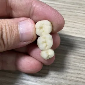 The Telescopic Crown Precision Attachment Denture Has Strong Stability thumbnail-2