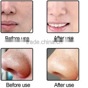Black Head Remover Machine thumbnail-4