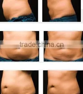 2016 Newest !!Fast Cellulite Reduction Machine / / Freezing Fat Cell Slimming Machine thumbnail-6