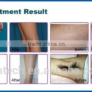 CE ISO Approved Portable Medical 808nm Diode Laser Hair Removal Machine With 160J/cm3 Energy thumbnail-4
