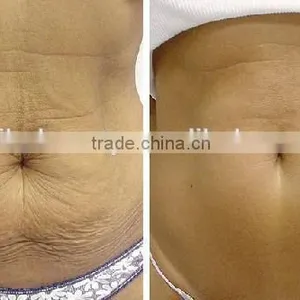 Portable Radio Frequency Fractional Magic Pot rf and Microneedle rf Wrinkle Removal Machine/ /home us thumbnail-6