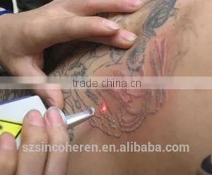 nd Yag Laser Tatoo Removal Machine Carbon Peeling Treatment for Skin Rejuvenation thumbnail-3