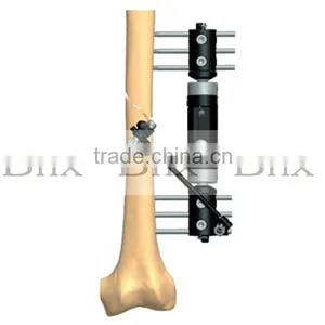 External Fixation For Bone Lengthening thumbnail-1