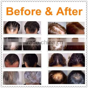 Hair Growth Electric Scalp Stimulator Device thumbnail-6