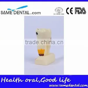 Dental Model School Teaching Dental Eduction Assitant No. DEA-15 4 Times Integrated Pathology Model thumbnail-2