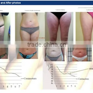 Latest Technology Slimming VelaSlim Body Shaping Machine thumbnail-6