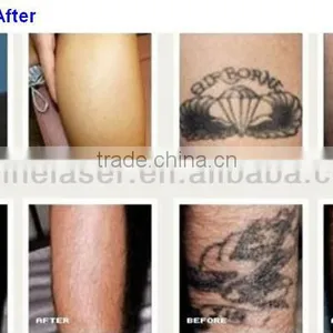 OEM Service Beauty Device 1064 nm 532nm Nd:yag Laser Q- Switched Nd YAG Laser Tattoo Removal/pigmentation/freckle Remove Machine thumbnail-4