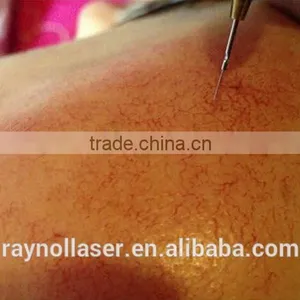 Smart Mini Spider Vein Removal Machine 30MHz RBS thumbnail-6