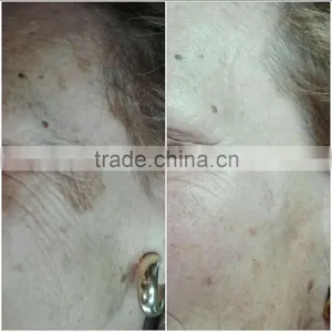 Fractional rf Microneedle Face Lifting Scar Removal Machine thumbnail-3