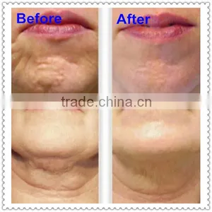 Professional Shr Ipl Hair Removal Machine thumbnail-6