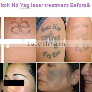 2016 New Year Best Q-Switch nd Yag Laser Tattoo Removal Treatment Machine thumbnail-5