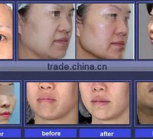 2016 Hifu Face Lifting Wrinkle No Pain Removal Beauty Machine HIFU U-one Eye Lines Removal thumbnail-6