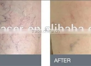 Newest 980nm Diode Laser for Anti-redness Therapy thumbnail-1