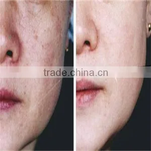 Fast Skin Rejuvenation and Tightening Beauty Machine Portable Fractional rf Microneedle thumbnail-6