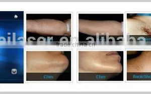 Hot Selling !!! 808nm Diode Laser Bikini Area Laser Hair Removal Machine thumbnail-6