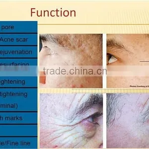 Radiofrequency Micro Needle rf Fractional&fractional rf Microneedle Machine thumbnail-6