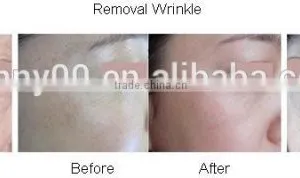 Hot Selling!! Fractional Co2 Laser For Superfacial Acne Remove Neoplasms Scar Surgery Equipment With Medical Ce And Iso Eliminate Body Odor thumbnail-3