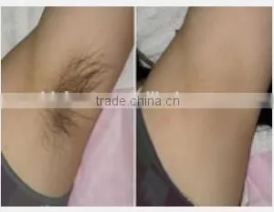 Supply Medical Affordable Permanent Hair Removal / at Home Laser Hair Removal Machines Keyword thumbnail-6