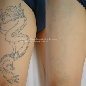 Q Switched Nd Yag Laser 1064nm&532nm Pigment Removal for Beauty Salon Use thumbnail-5