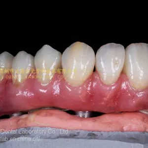 Dental Implant Prosthesis, Implant Denture, Dental Prosthesis, Laboratoire Dentaire, Dentallabor, Laboratorio Dental, Dental Laboratory, Shenzhen LJ Dental Lab China thumbnail-4