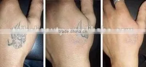 2016 Most Effective Best Q Switch Nd Yag Laser 1000W Machine For Tattoo Removal Birthmark Removal And Pigmentation Treatment 1-10Hz thumbnail-6