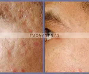 2016 Lowest Distributor Price: Super Pulse Co2 Laser for Skin Refreshing Scar Remov for Acne Scars Treatment , Burn Debridement thumbnail-3