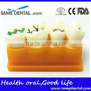 Pit and Fissure Model Dental Eduction Assistant No. DEA-19 thumbnail-2