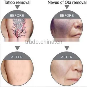 Best China Hot Sale!! Super Fast Color Touch Screen Medical Tattoo Removal Equipment 10HZ thumbnail-6