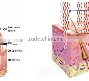 Ultra Pulse Laser Surgery Treatments Vaginal Mucosa Tightening Fractional Co2 Laser thumbnail-5