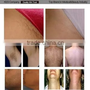 2016 Hot Sale 808nm Diode Laser Hair Removal Machine/hair Removal Speed 808 thumbnail-6