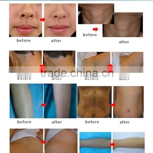 Abdomen Professional Diode Laser 810 Hair Removal Machine Whole Body thumbnail-6