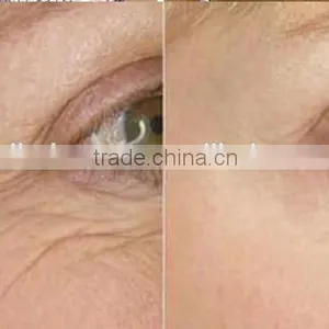 Low Price Radio Frequency rf Wrinkle Remover Machine for Sagging Skin Treatment and Pore Treatment thumbnail-6