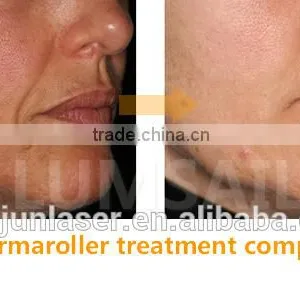 Proffesional 540 Needles Stainess Steel and Titanium Derma Roller thumbnail-4