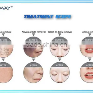 Distribution Price Picosure Laser q Switched nd Yag Laser Tattoo Removal With CE thumbnail-2