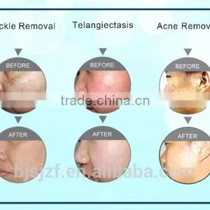 SH-1 2016 Newest Products Male Hair Removal Beauty Equipment With Diode Device thumbnail-6