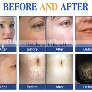 Mini Skin Needling for Home Use for Salon thumbnail-6