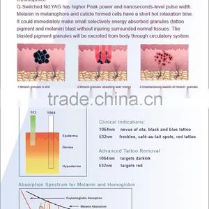 nd Laser Tattoo Removal Vertical q Switched nd Yag Laser Machine thumbnail-3