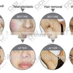 OD-A900 Beauty Machine for Skin Rejuvenation Fast Hair Removal Portable Ipl thumbnail-4