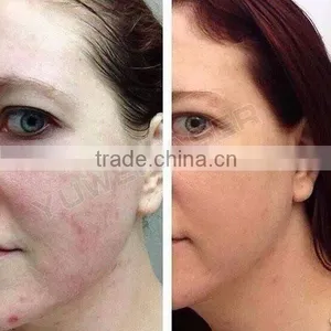 CE Approved Scar Removal Fractional RF Equipment With Best Cooling System thumbnail-5