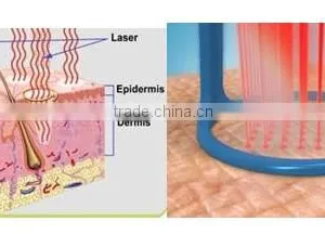 High Quality Power Skin Whiten and Tighten Spots Scar Wrinkle Removal Machine Fractional Co2 thumbnail-5